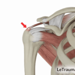 Illustration médicale de la tendinite de l’épaule montrant l’inflammation du tendon du supra-épineux sous l’acromion, avec mise en évidence de la zone douloureuse responsable des douleurs de l’épaule, image pédagogique LeTraumato.com