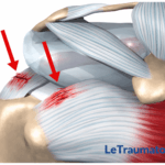 Illustration médicale en 3D de la tendinite de l’épaule montrant l’inflammation du tendon du supra-épineux sous l’acromion avec zones inflammatoires en rouge, image pédagogique destinée à expliquer les douleurs de l’épaule liée à une tendinopathie, réalisée pour LeTraumato.com
