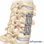 Schéma médical d’une arthrodèse cervicale avec plaque et vis fixant les vertèbres du cou