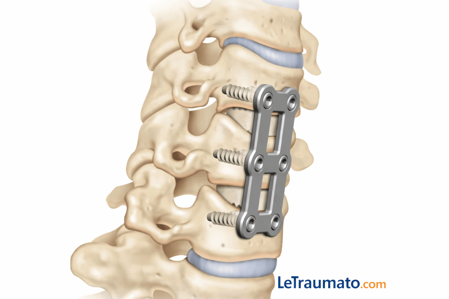 Schéma médical d’une arthrodèse cervicale avec plaque et vis fixant les vertèbres du cou