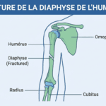 Image explicatif de: fracture de la diaphyse de l’humérus et fracture du corps de lhumérus