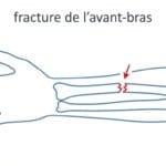 Image explicatif de: fracture de l’avant-bras et cassure de l’avant-bras