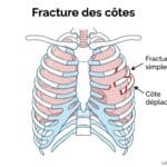 Image explicatif de: fracture des côtes et cassure des côtes