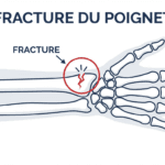Image explicatif de: fracture du poignet et rupture du poignet