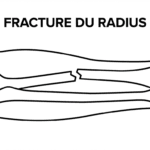 Image explicatif de: fracture du radius et cassure du radius