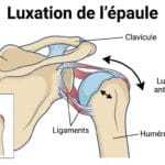 Image explicatif de: Luxation de l’épaule et Déboîtement de lépaule