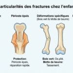 Image explicatif de: particularités des fractures chez l’enfant et caractéristiques des fractures pédiatriques