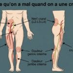 Image explicatif de: Où est-ce qu'on a mal quand on a une cruralgie ? et Douleur de la cuisse