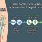 Image explicatif de: Quand commencer la kinésithérapie après une fracture pertrochantérienne ? et Début kiné fracture hanche