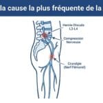 Image explicatif de: Quelle est la cause la plus fréquente de la cruralgie ? et Quelle est la raison la plus courante de la cruralgie ?