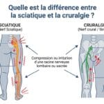 Image explicatif de: Quelle est la différence entre la sciatique et la cruralgie ? et Quelle est la distinction entre la sciatique et la névralgie fémorale ?