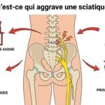 Image explicatif de: Qu'est-ce qui aggrave une sciatique ? et Facteurs aggravants sciatique