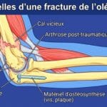 Image explicatif de: Séquelles d'une fracture de l'olécrane et Conséquences dune fracture de lolécrane